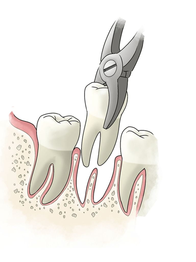 Простое удаление постоянного зуба
