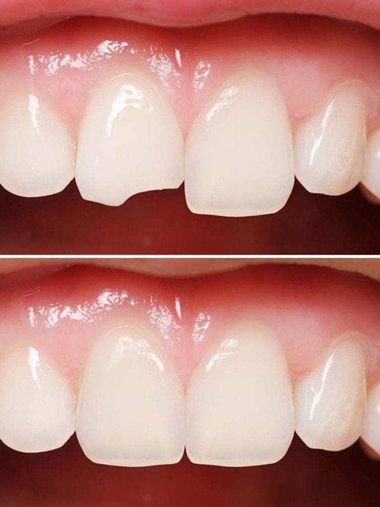 Восстановление зуба пломбой