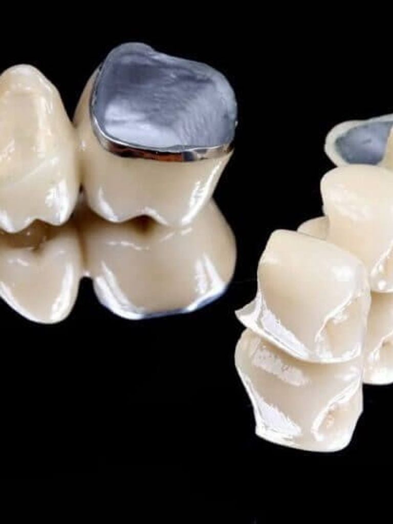 Металлокерамическая коронка