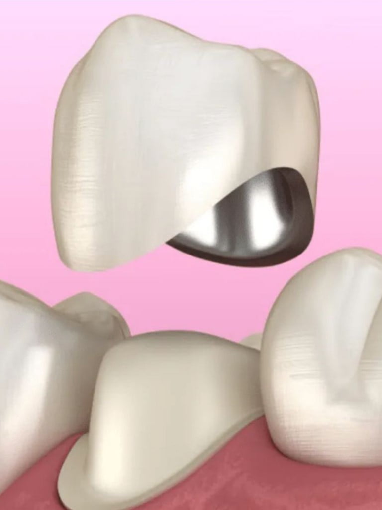 Установка металло-керамической коронки на 1 зуб