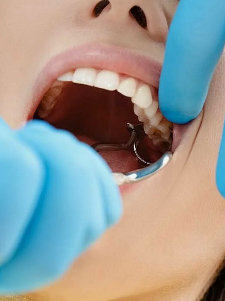 Лечение кариеса + установка светоотверждаемой пломбы