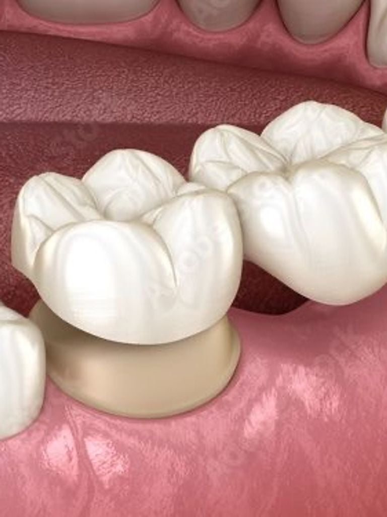 Установка коронки