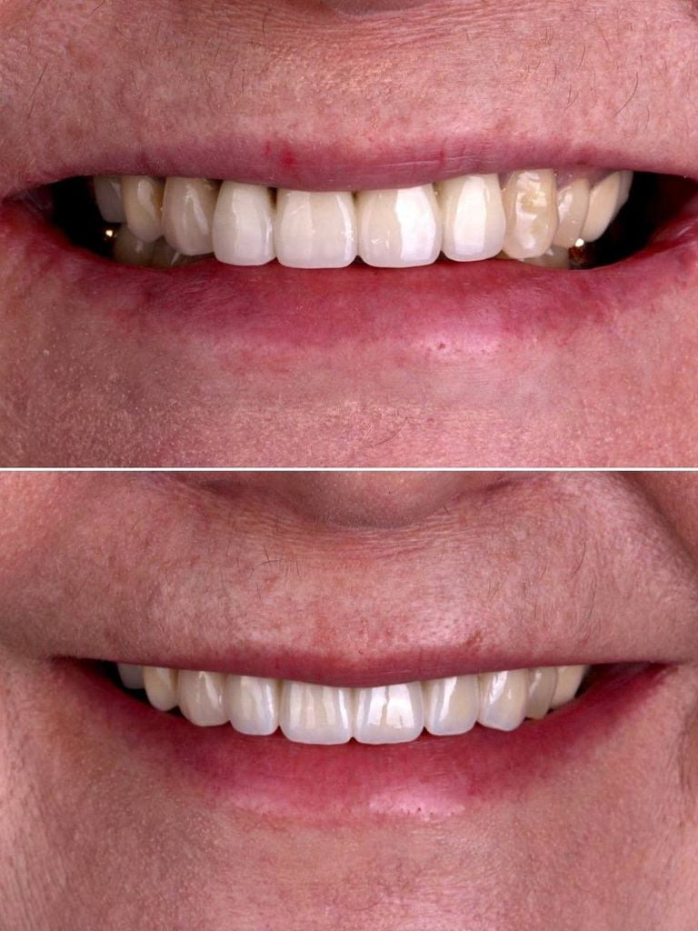 Установка коронки из диоксида циркония (Япония)