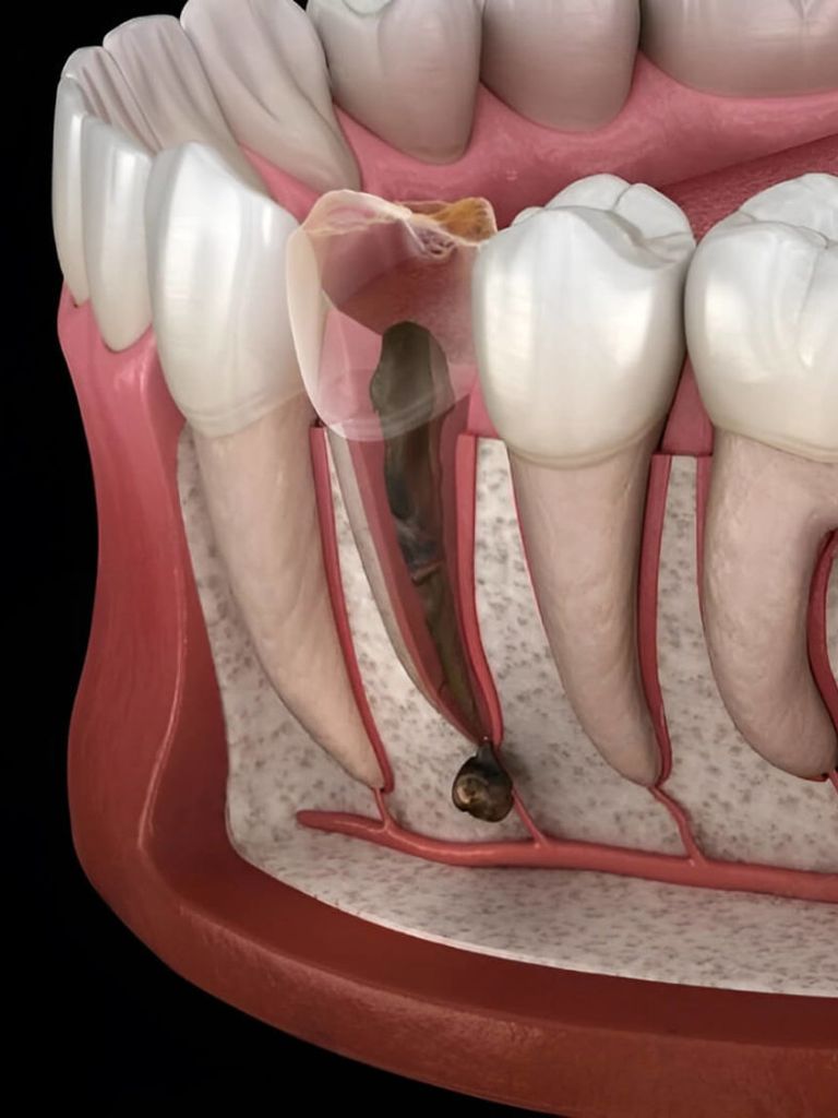 Лечение периодонтита