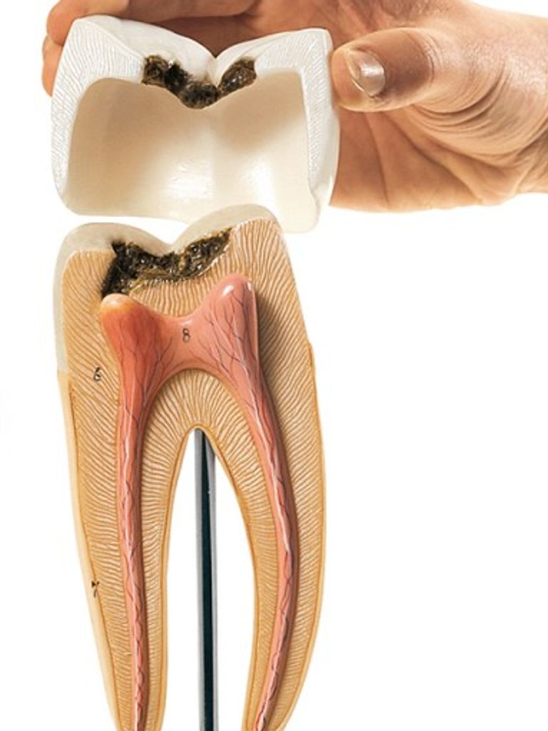 Лечение кариеса 1 зуба