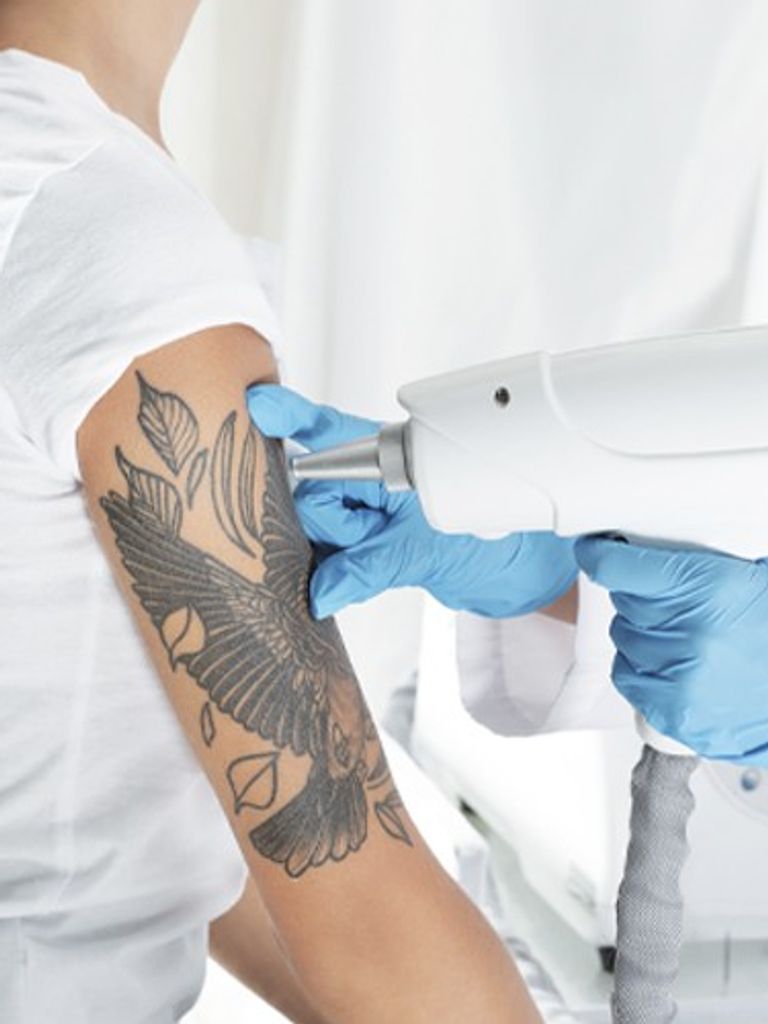 Удаление татуировок