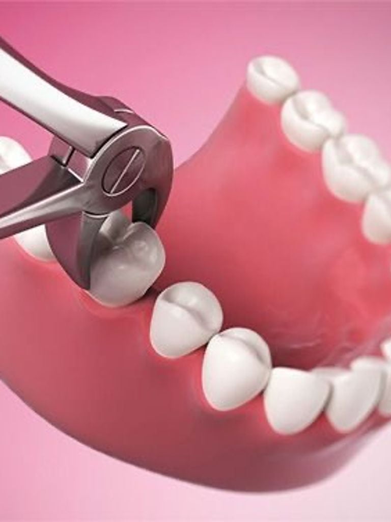 Удаление зуба