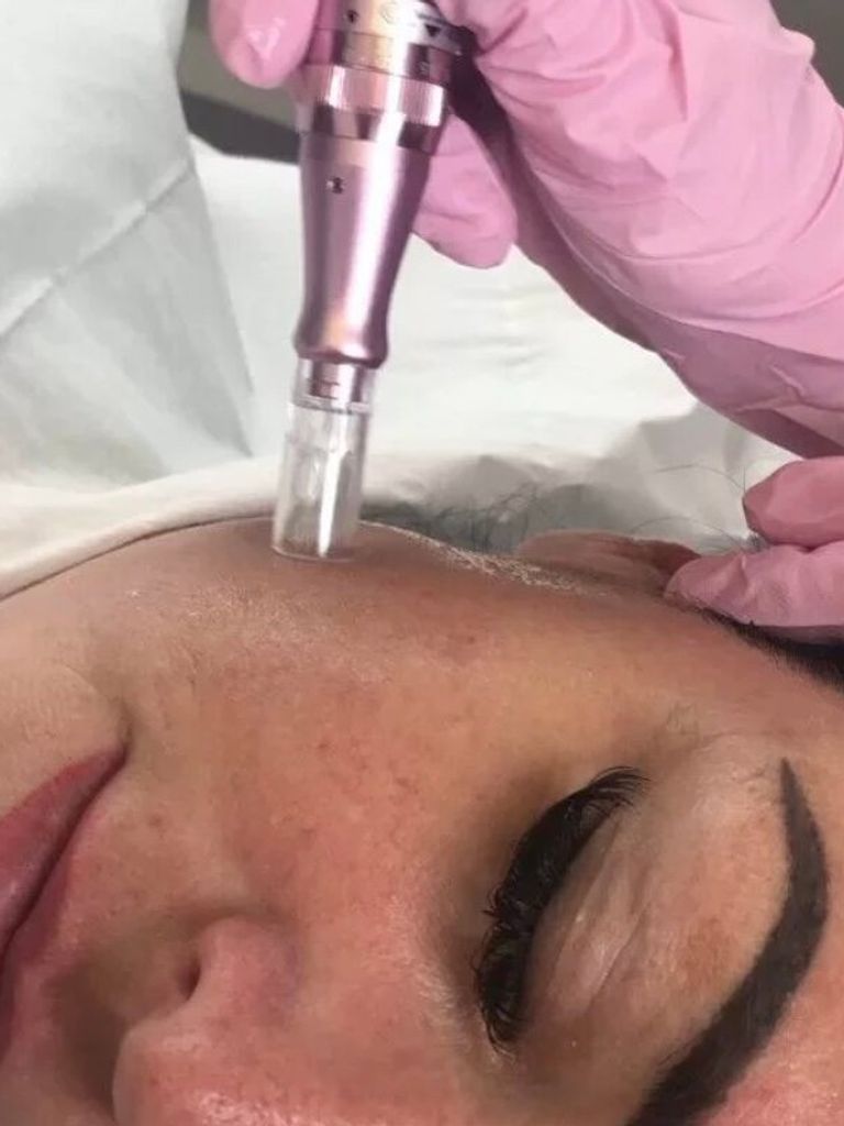 Фракционная мезотерапия (микронидлинг) лица