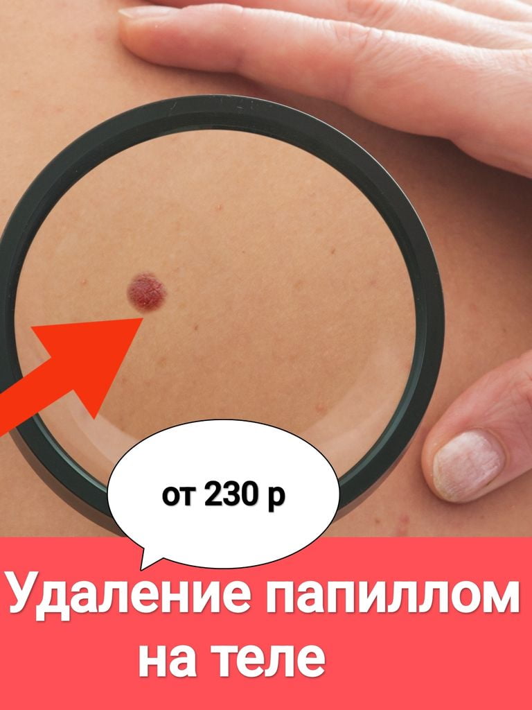 Удаление папилломы на теле