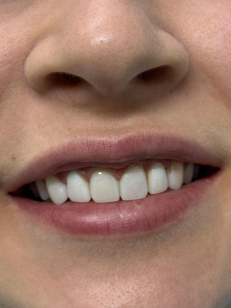 Установка коронки из диоксида циркония