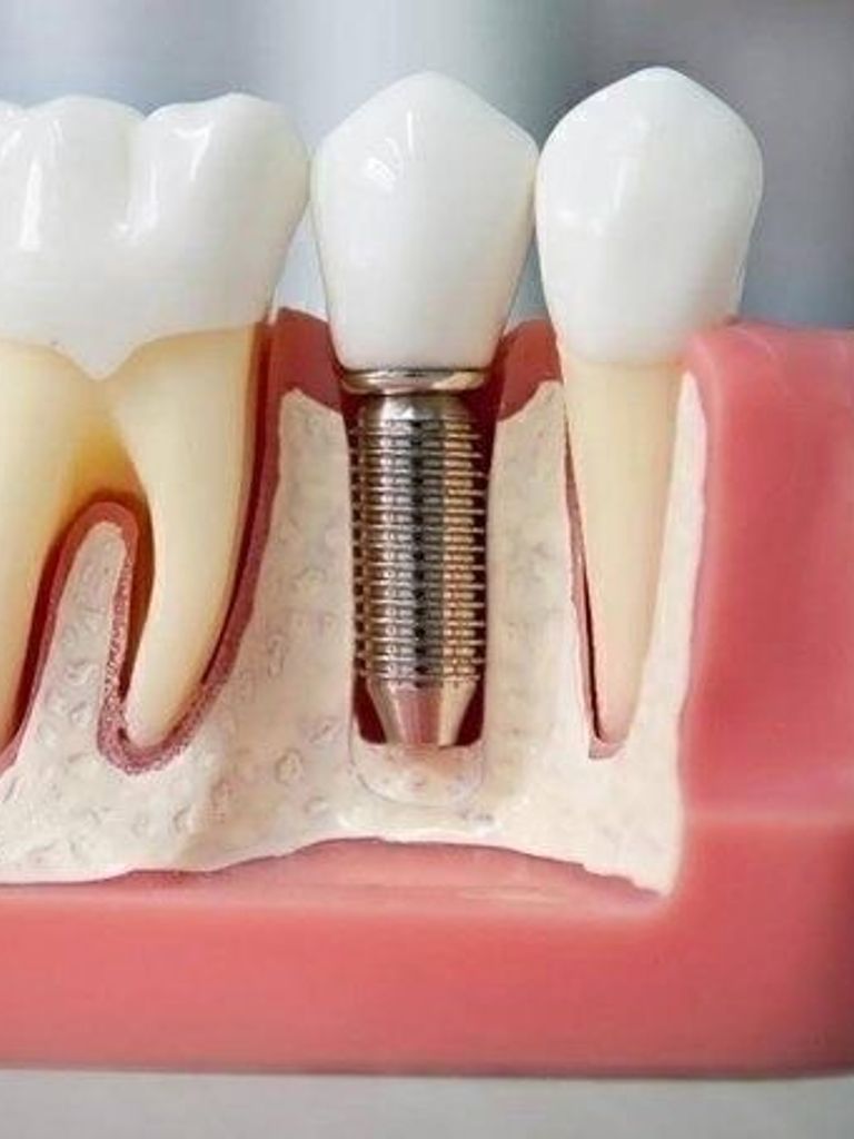 Имплантация 1 зуба Implantium (Корея) (имплант + коронка)