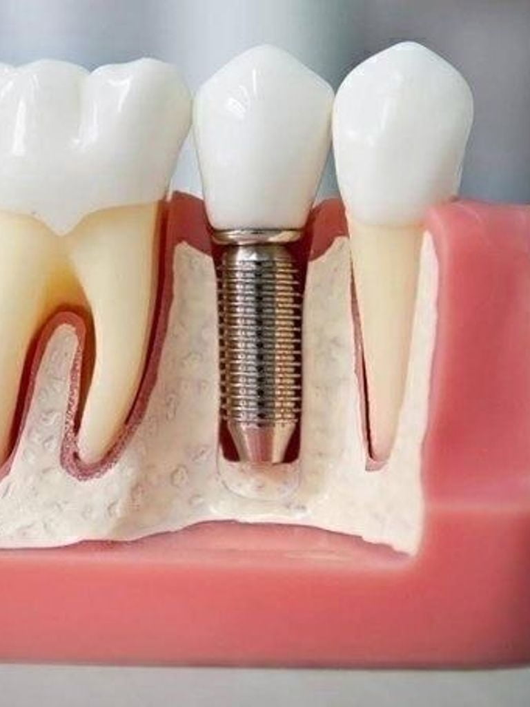 Имплантация 1 зуба Implantium (Корея) (имплант + коронка)