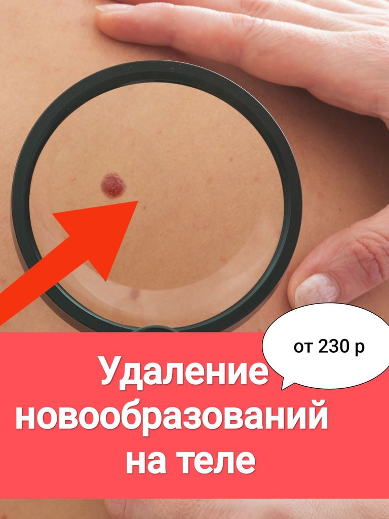 Удаление новообразований на теле