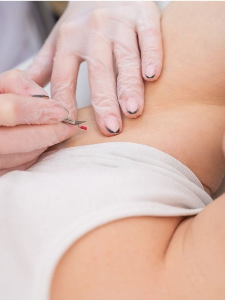 Электроэпиляция малой зоны лица или/и подмышечных впадин (ул. Горчакова)