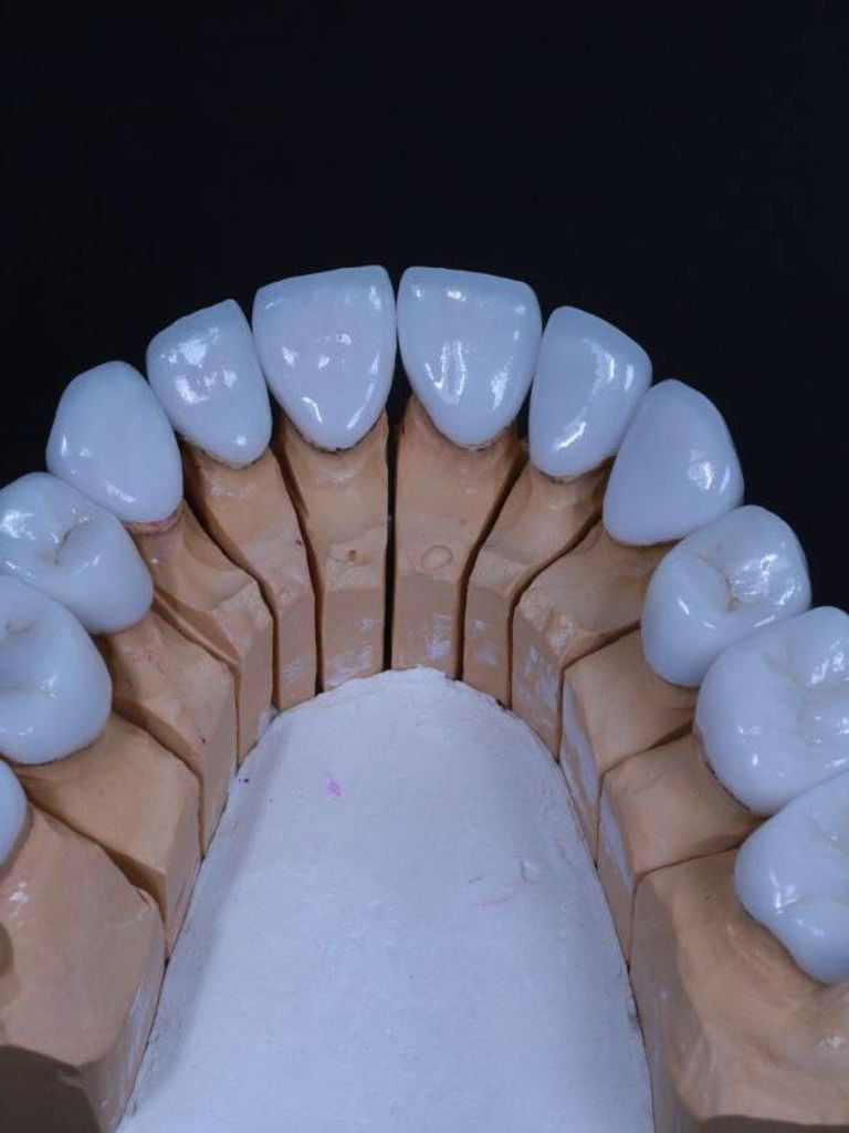 Установка коронки из диоксида циркония (Япония)