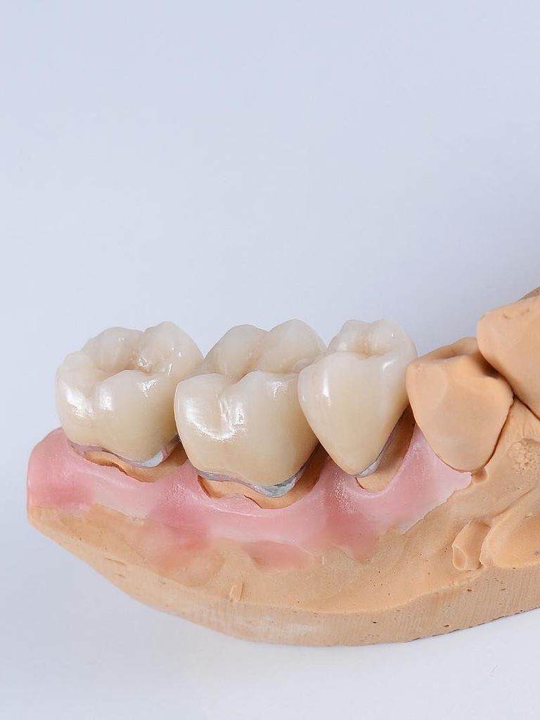 Установка металлокерамической коронки