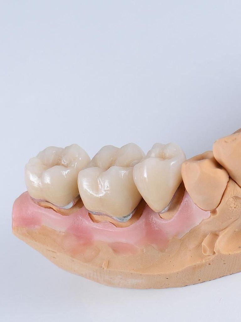 Установка металлокерамической коронки