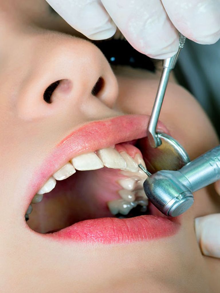 Лечение кариеса