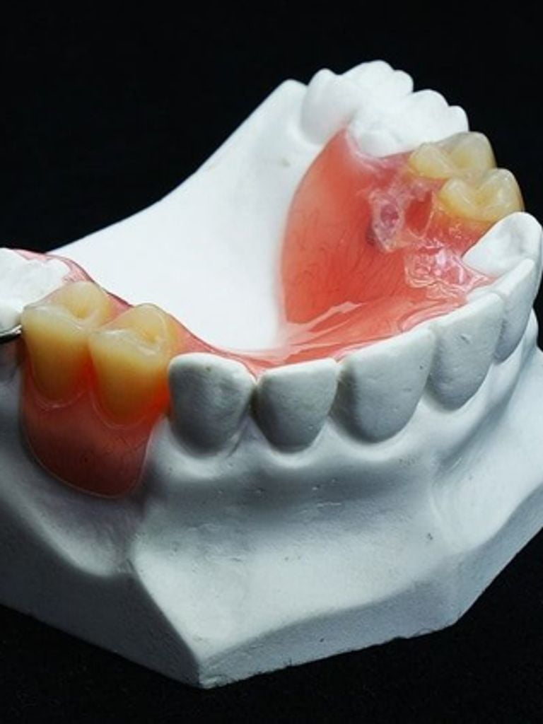 Изготовления частично-съемного протеза Villacryl