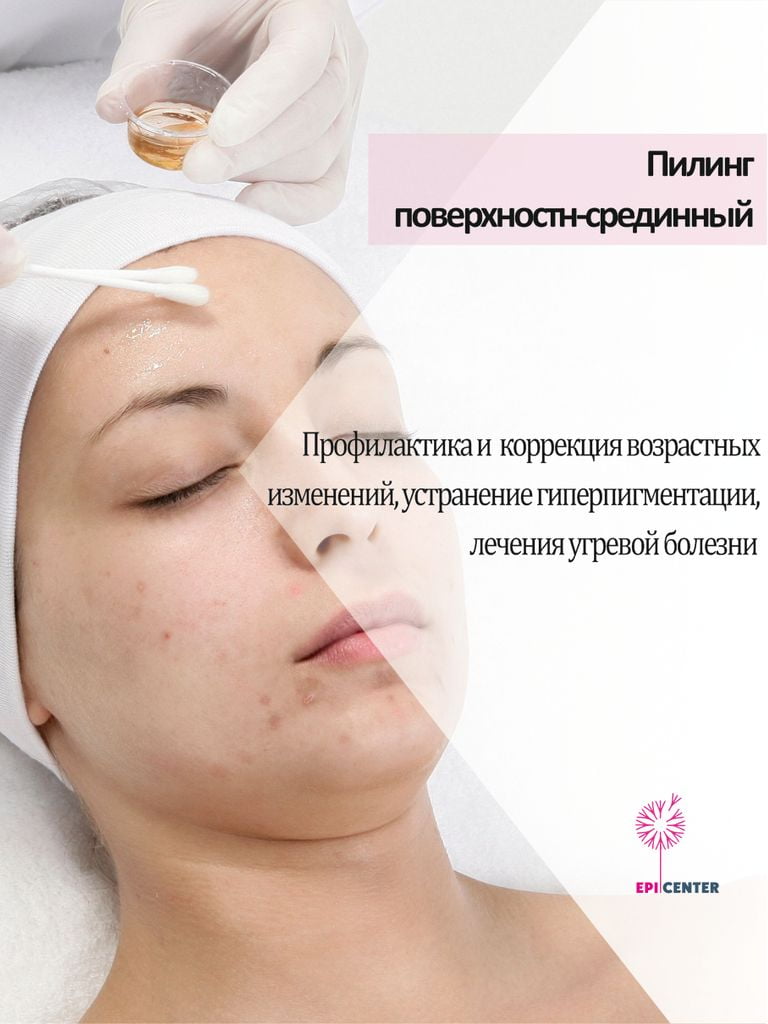 Поверхностно-срединный пилинг