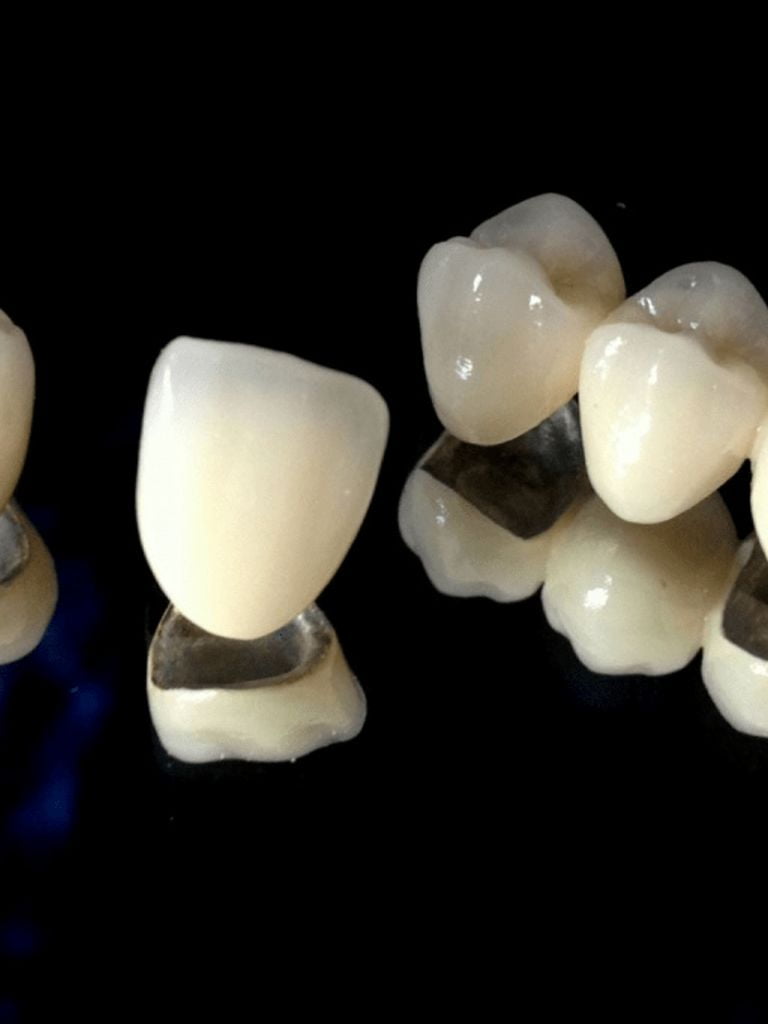 Установка металлокерамической коронки Noritake (Япония)