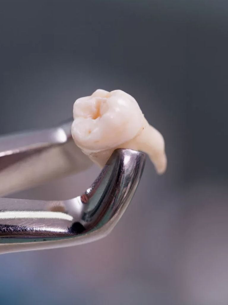 Удаление зуба мудрости