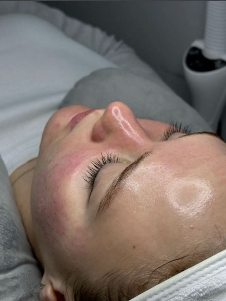 Фракционная мезотерапия лица дермапеном