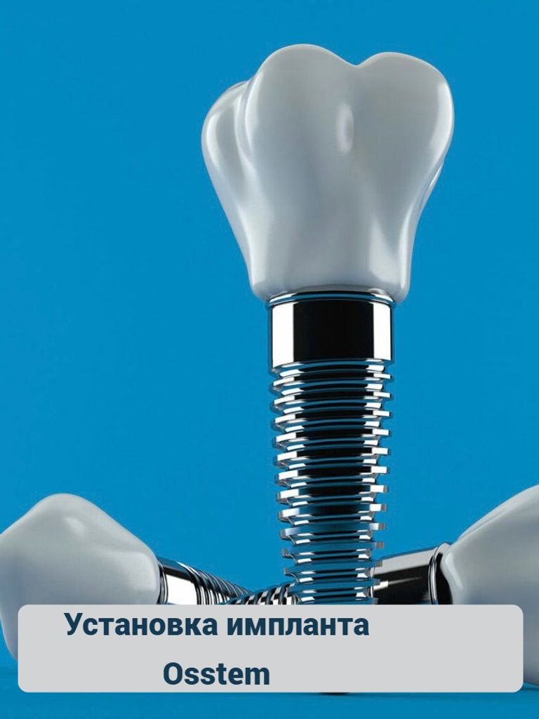 Установка импланта Osstem