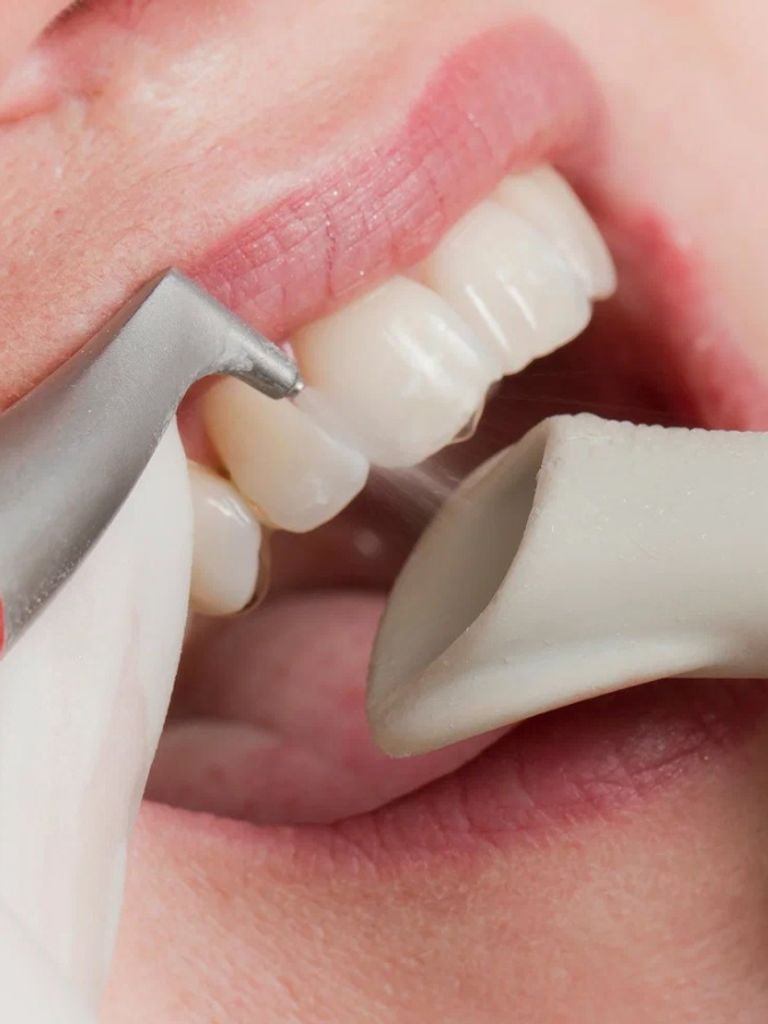 Профессиональная гигиена полости рта с Air Flow