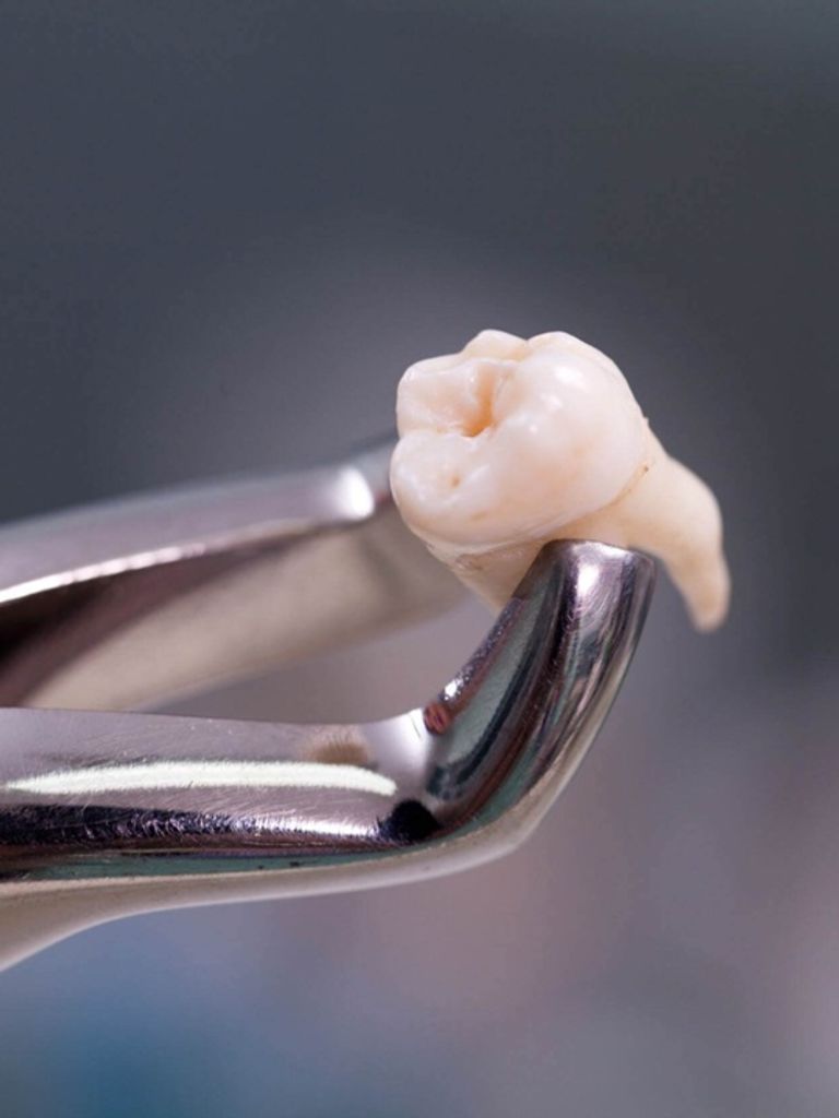 Удаление зуба