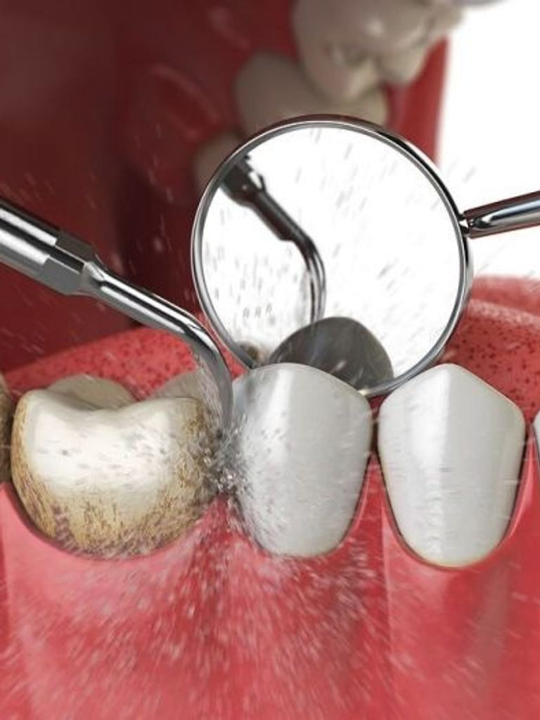 Гигиена полости рта + Air Flow