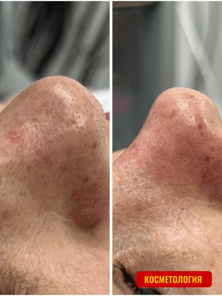 УЗ-чистка лица, 60 мин.