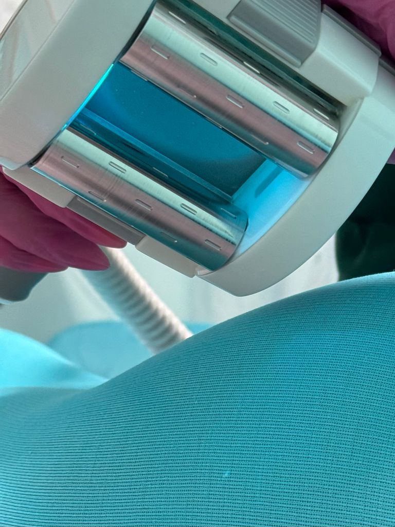 LPG-массаж тела