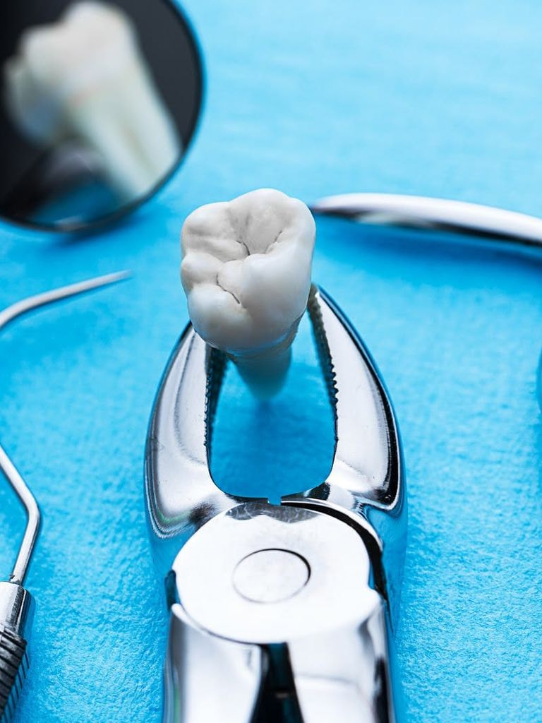 Удаление зуба