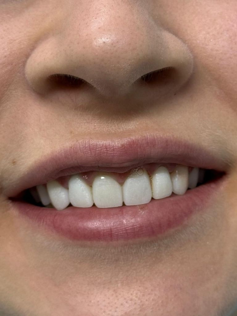 Установка коронки