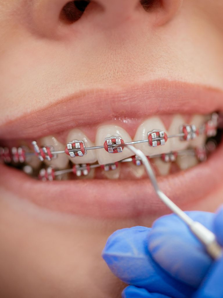 Брекет-система