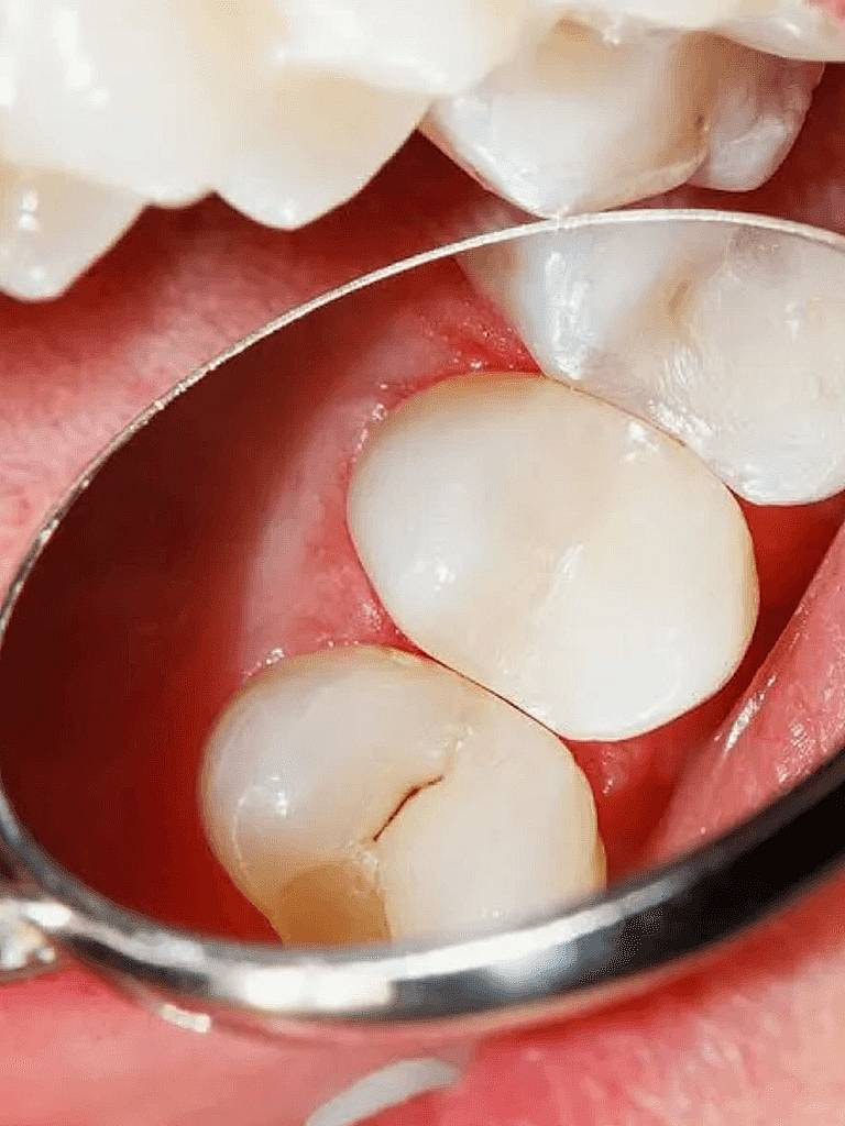 Лечение кариеса