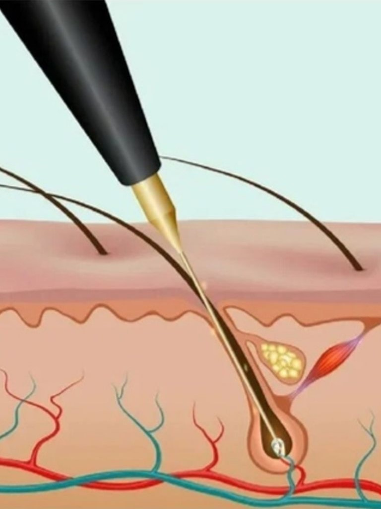 Электроэпиляция