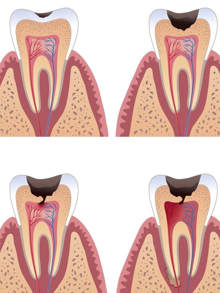 Лечение кариеса 1 зуба для взрослых