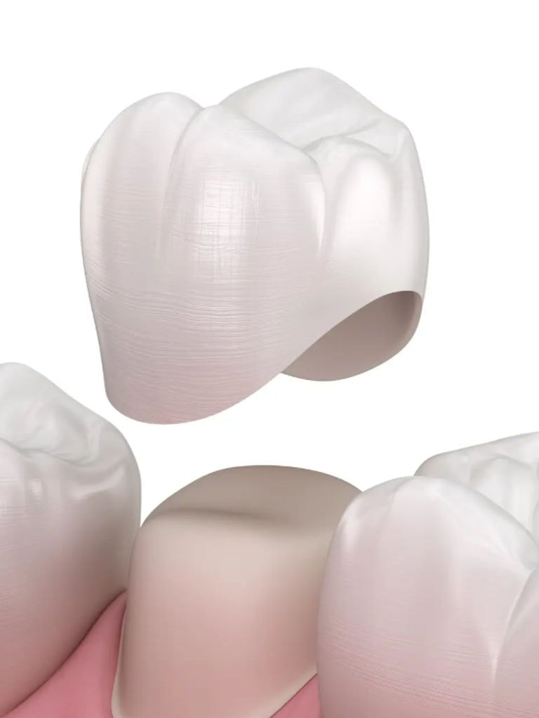 Установка коронки