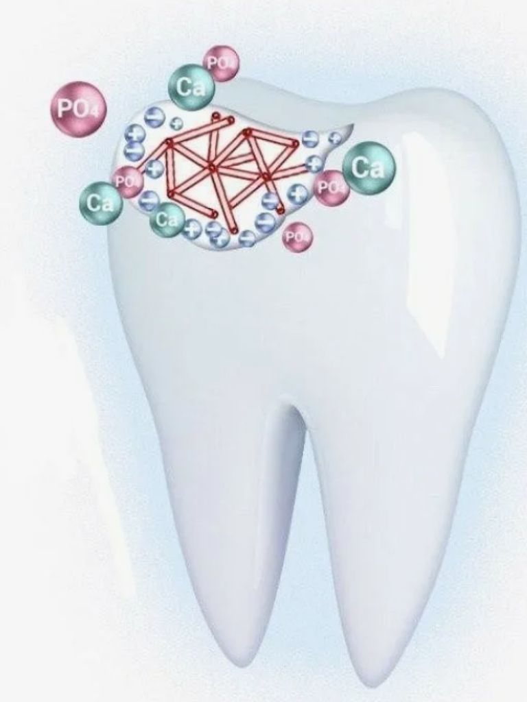 Биореминерализирующая терапия (профилактика кариеса)