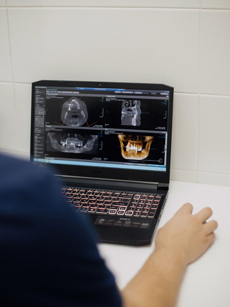 Имплантация "Всё на 4"