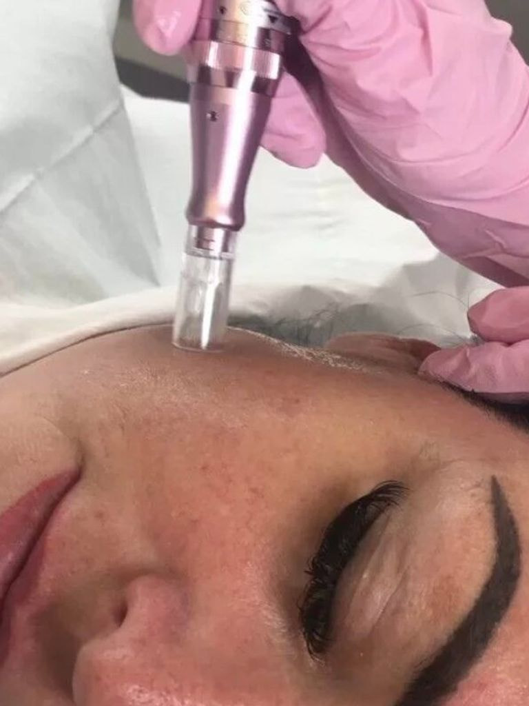 Фракционная мезотерапия (микронидлинг) + пилинг