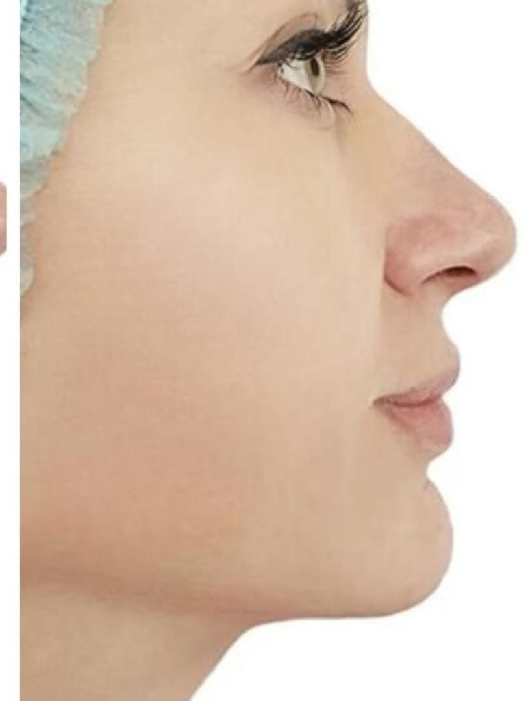 Коррекция овала лица (средняя и нижняя треть) нитями