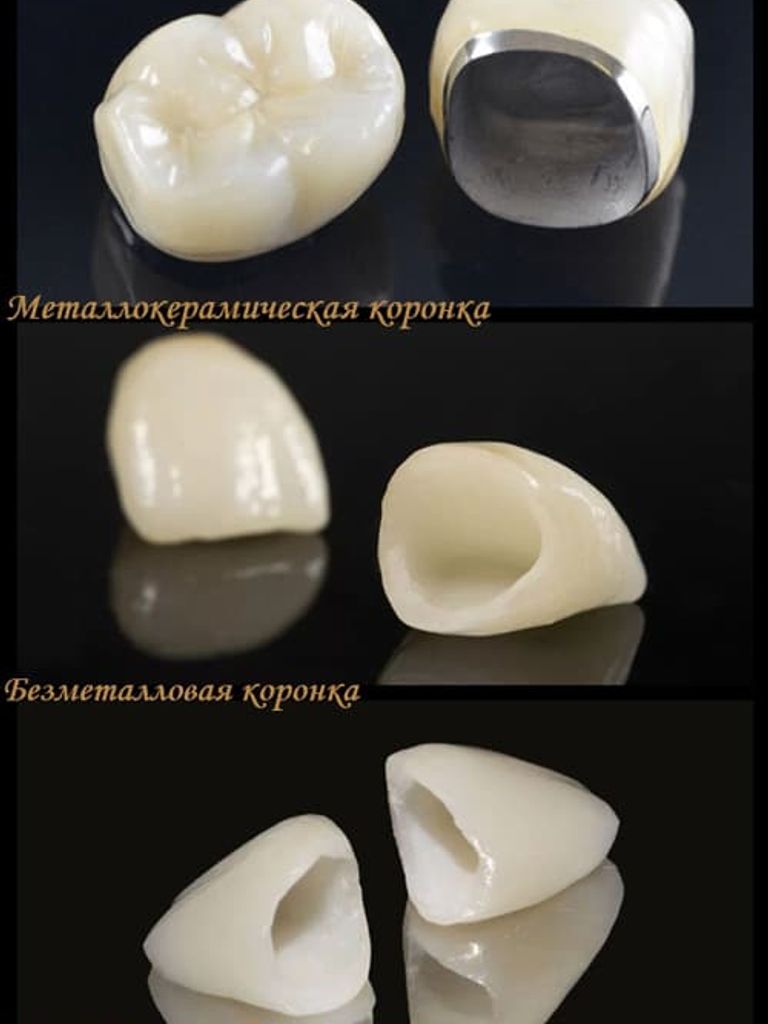 Металло-керамическая коронка