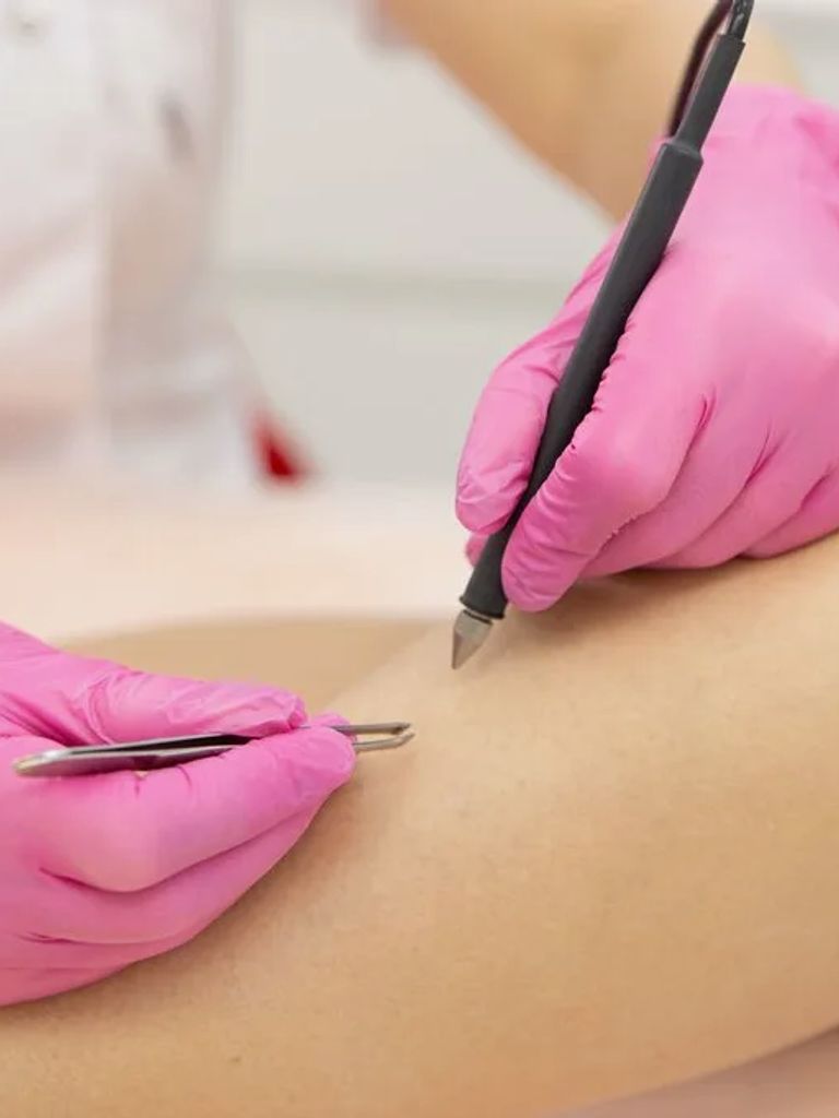 Электроэпиляция