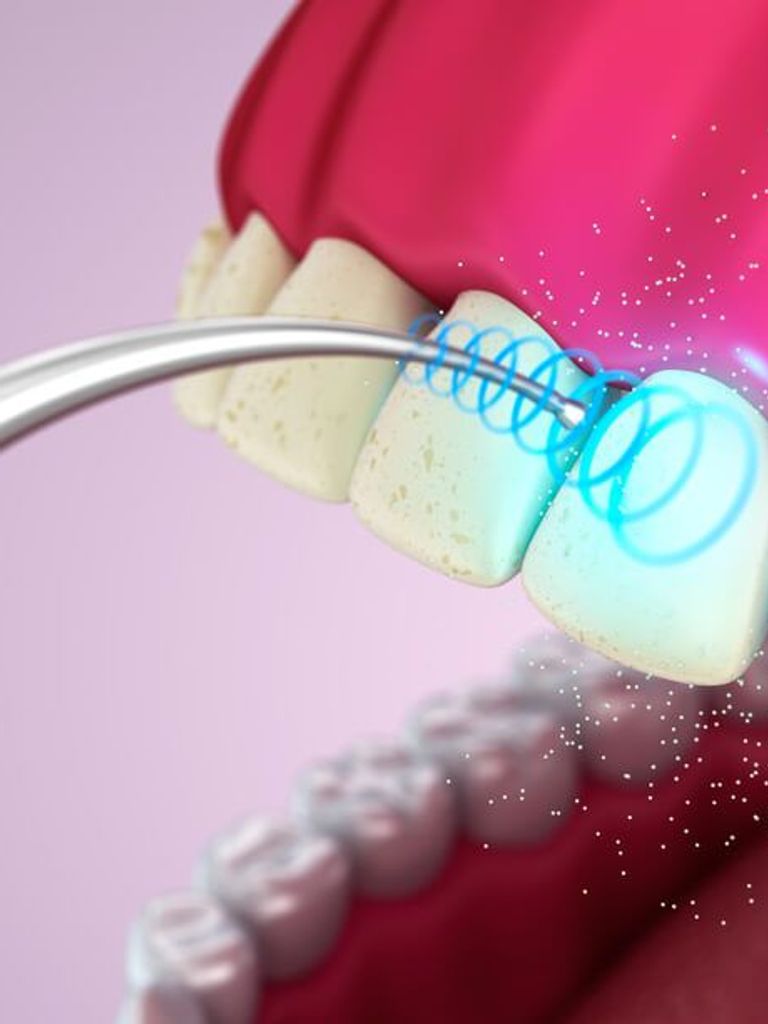 Профессиональная гигиена полости рта с ультразвуком