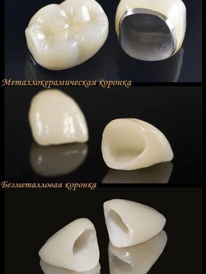 Металло-керамическая коронка