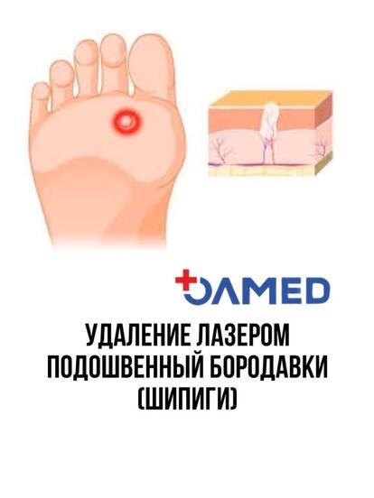 Удаление подошвенной бородавки (шипицы, шипиги)